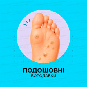 Видалення підошовних бородавок (подлогічний метод)