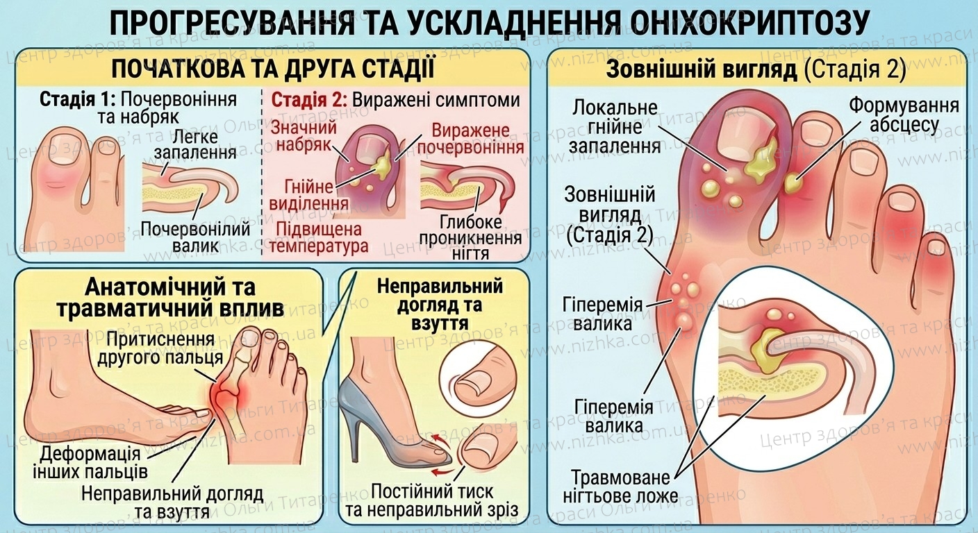 Симптоми другої стадії оніхокриптозу (врослого нігтя)