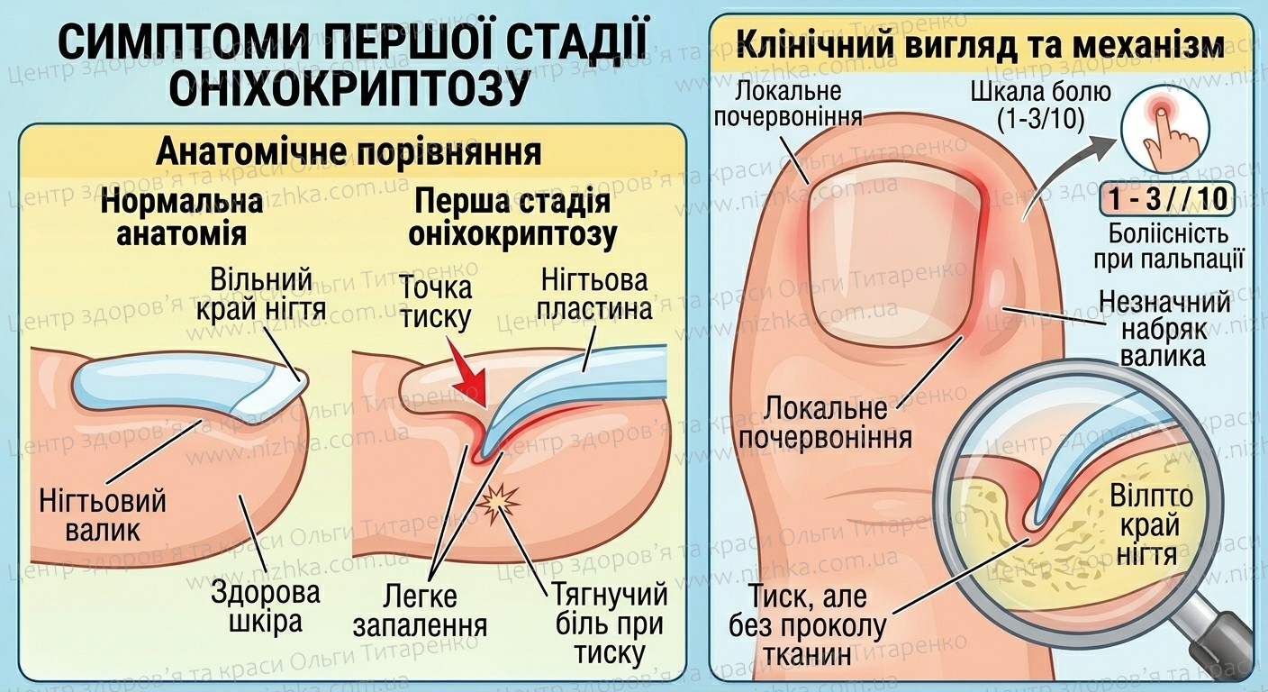 Симптоми першої стадії оніхокриптозу (врослого нігтя)