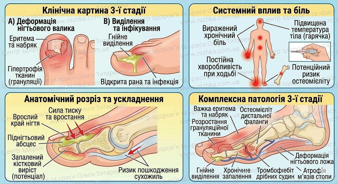 Симптоми третьої стадії оніхокриптозу (врослого нігтя)