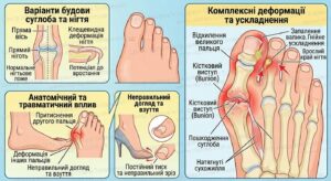 Вальгусна деформація стопи («кісточка» на великому пальці ноги)
